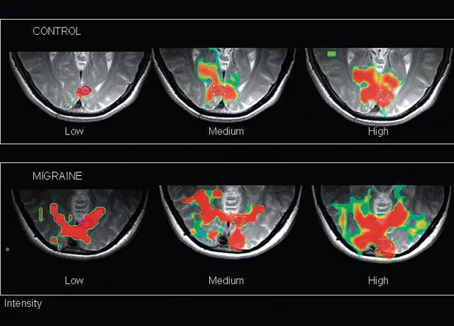 ¿Cómo sienten el dolor quienes padecen migraña?