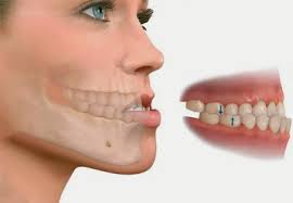 Cirugía Ortognática para problemas dentofaciales 1 cirugia ortognática 2