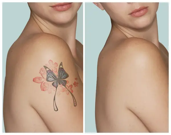 Antes y después de remover el tatuaje
